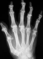 /album/a3/osteoartrose-ii-png/